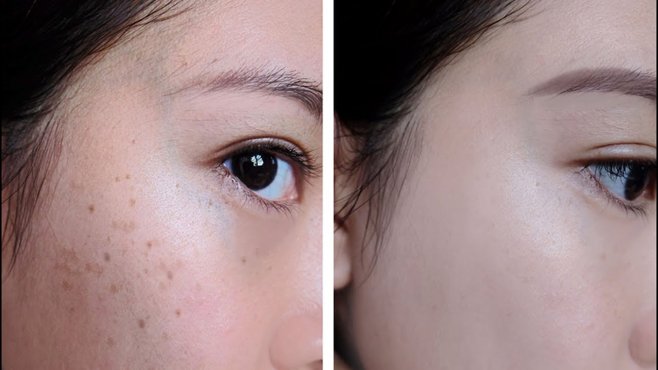 Como remover sardas do rosto rapidamente?